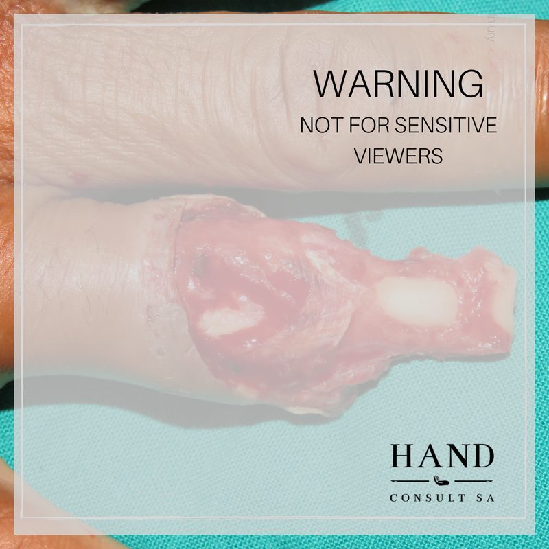 Finger Avulsion Injury