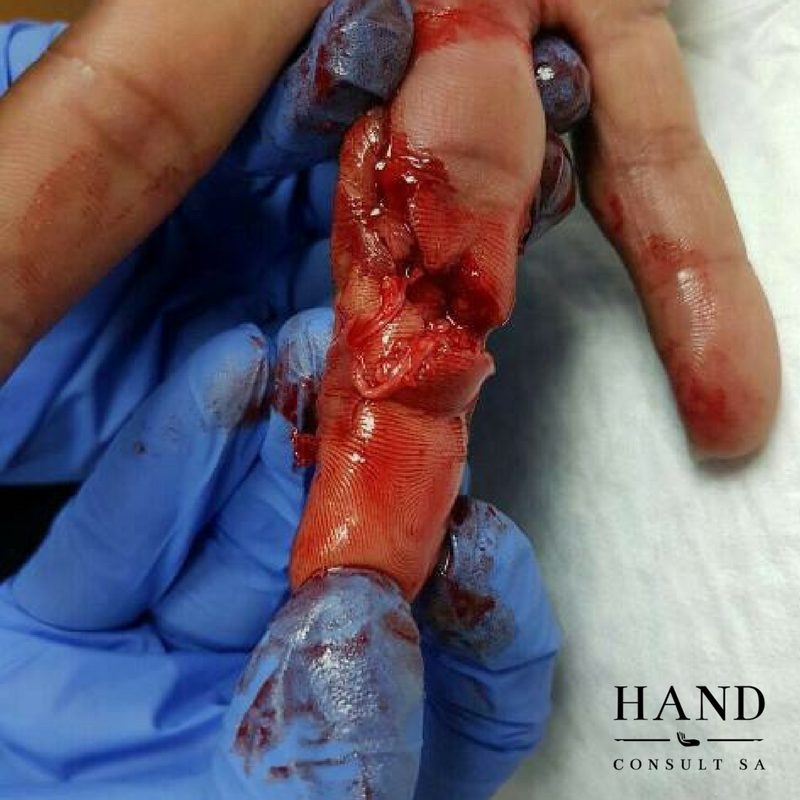 Finger Avulsion Injury - Outcome