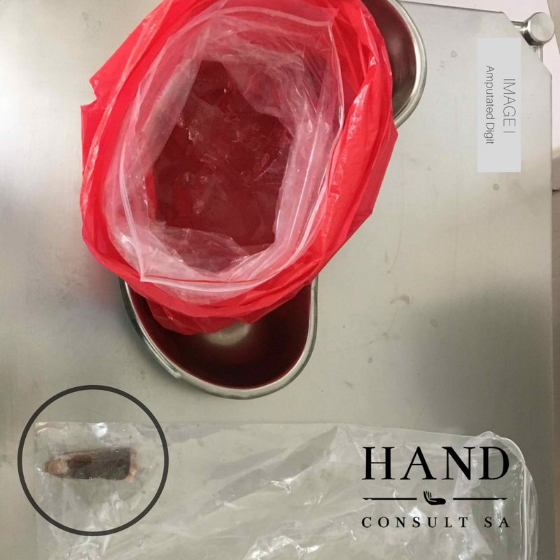 How do you store an amputated digit?