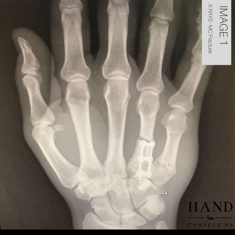 Fractured Hand